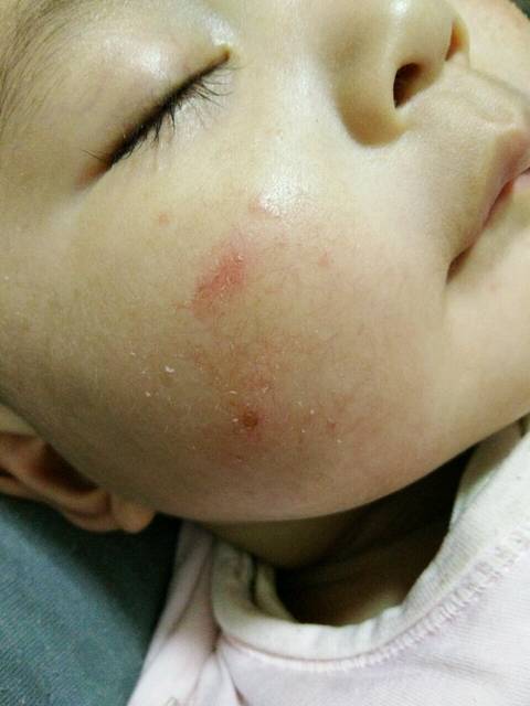 有经验的宝妈,给点意见_孩子出湿疹之后用了药