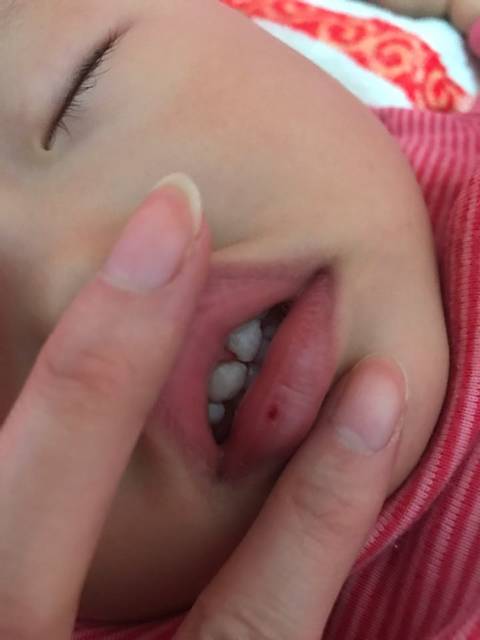 求助!_宝宝上牙龈磕破了嘴肿了有淤血怎么办?