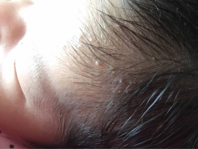 宝宝头上是湿疹还是痱子?_宝宝才一个多月,头