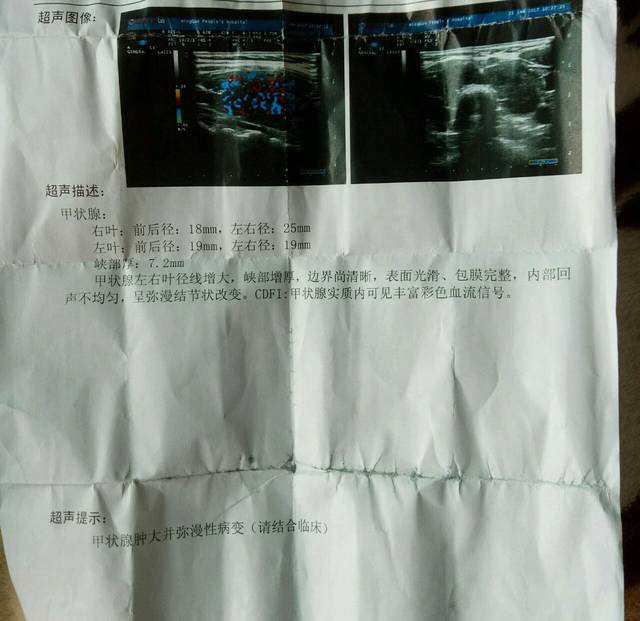 上海瑞金医院看甲状腺当天去能挂到号吗