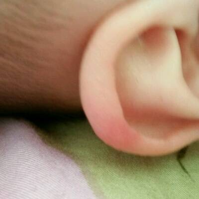 宝宝耳朵长了个红疙瘩,几天了还不好,湿疹一天就下去了,这是什么?