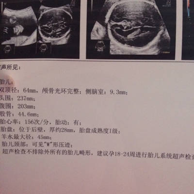 怀孕25周之前去做四维彩超医生说宝宝的侧脑