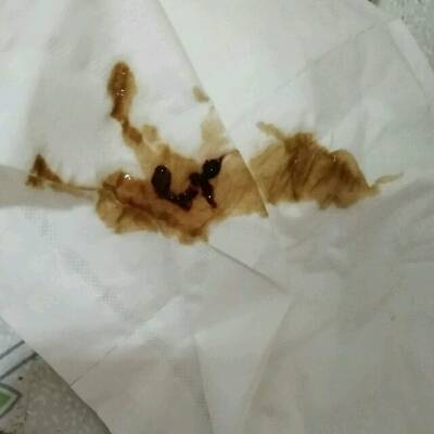 现在怀孕已经45天了,今天上厕所排出鲜血和碎血块,医生说有先兆流产