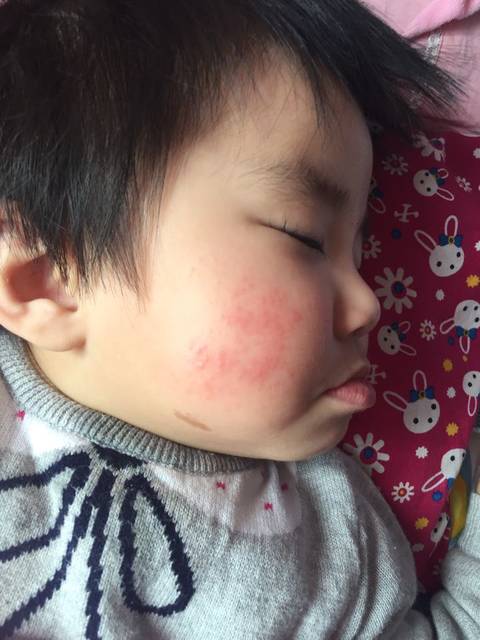 一岁半的宝宝脸上长了好多疹子。_不疼不痒的