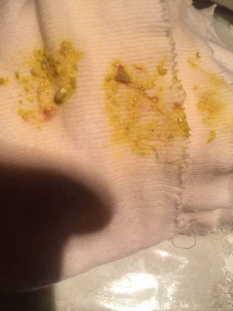 大便有红怎么回事?_干满月的宝宝大便带点红