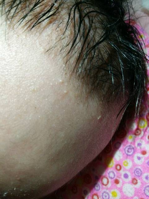 帮我看看吧_宝宝头上长这种痘痘是怎么回事啊
