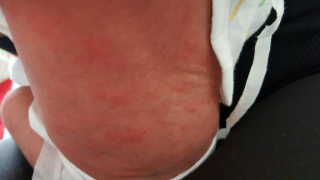 这样的红点点算湿疹吗?_宝宝刚出生一周,背后