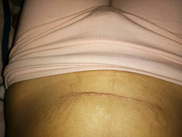 剖腹产怀二胎了刀疤这样的可以要吗