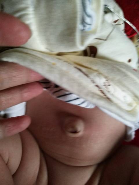 宝宝两个月了_宝妈们孩子有脐疝怎么办