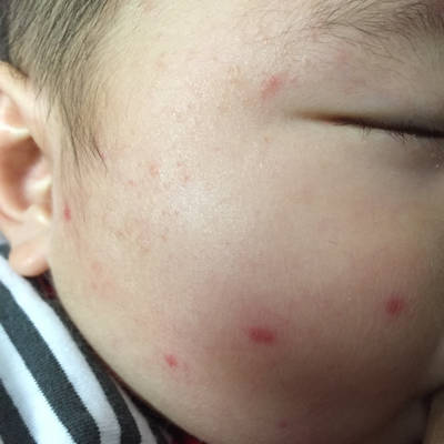 宝宝五个月,早上起来脸上长了许多小红点,都一