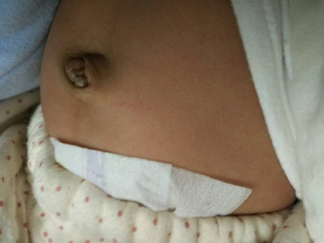 肚脐发炎长肉芽怎么治疗?