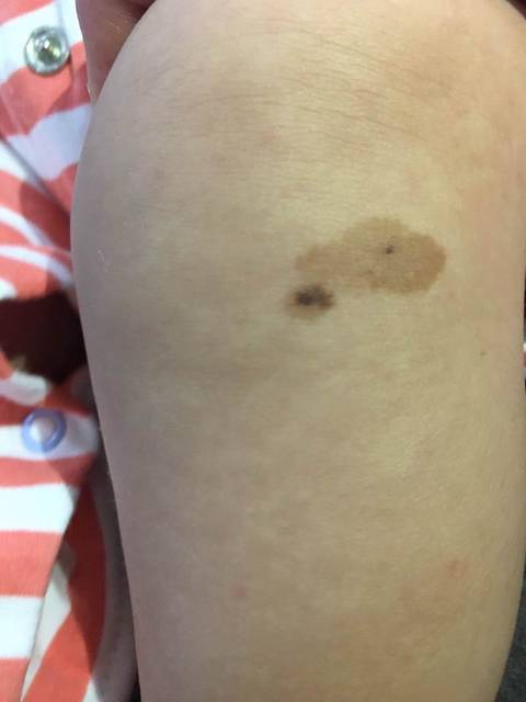 请问这是黑色素痣吗?很担心!