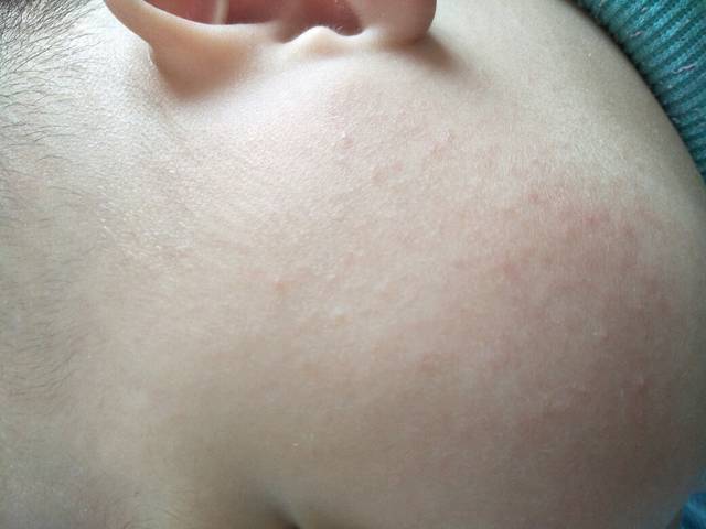 脸上红疙瘩怎么回事宝宝_脸上红疙瘩怎么回事