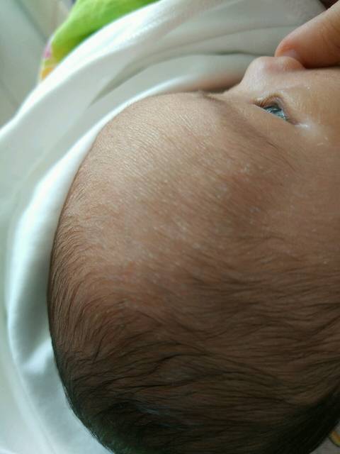 宝宝出生10天了,现在脑门和头发里面很多密密