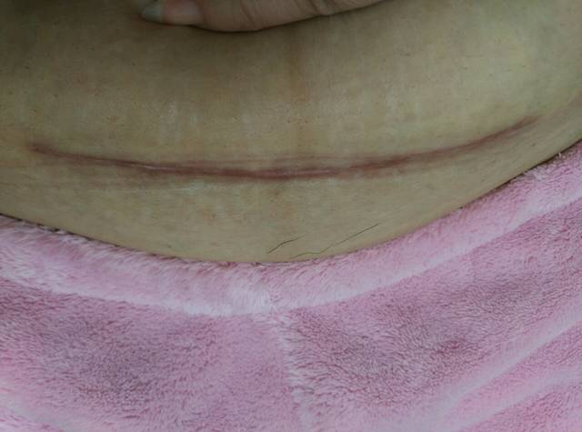 剖腹产后三个半月的刀口,看图片,是增生了吗?