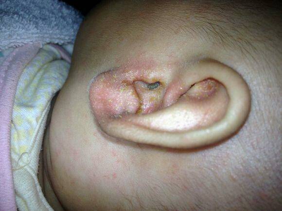 快两个月的宝宝'耳朵周围都是黄油样的分泌物