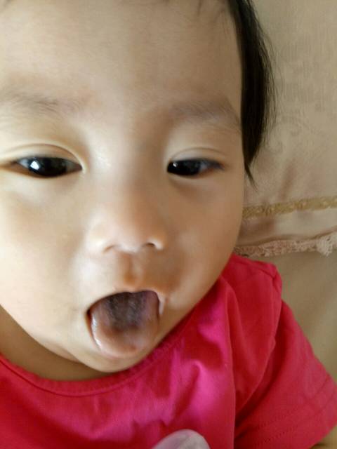 宝宝舌苔发黑。_宝宝10个月了,舌苔发黑,一个