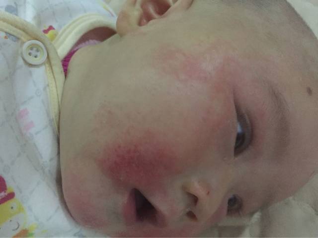 宝宝湿疹好严重,求好的治疗方法