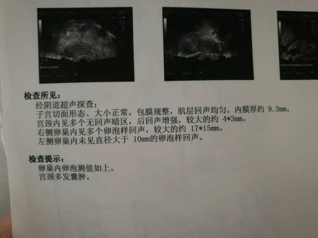 这个卵泡大小是快排了吗?