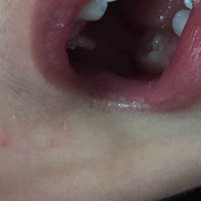 宝宝长牙期间,在牙龈上长了个肉芽,这正常吗?