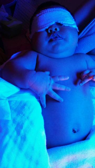 转让家用黄疸蓝光灯一套_宝宝出生黄疸,在医院