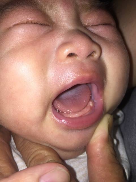 三个月宝宝牙龈上长出白色像牙齿一样的小白点