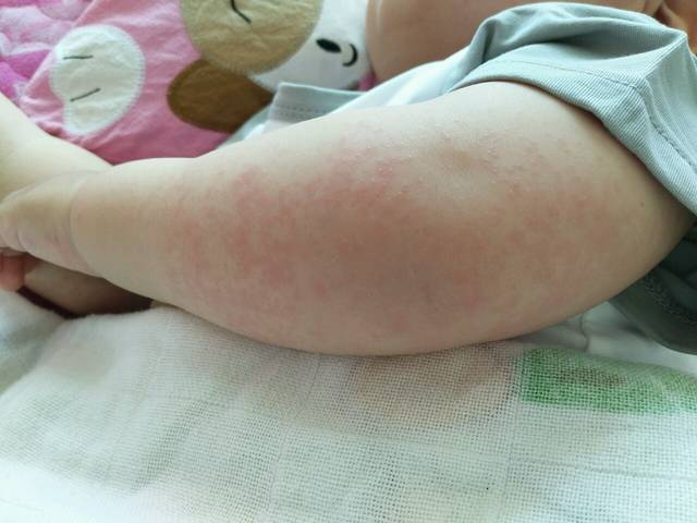 过敏性皮疹用什么比较好_四周岁宝宝手腕上发