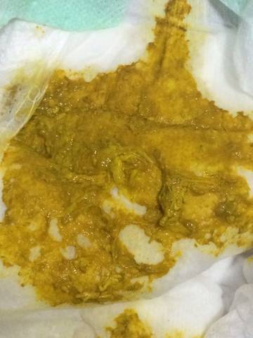 便便有9种颜色,只有3种是健康的(附健康九色卡