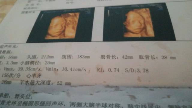四维看男女准嘛?_24周去做四维排畸,宝宝发育