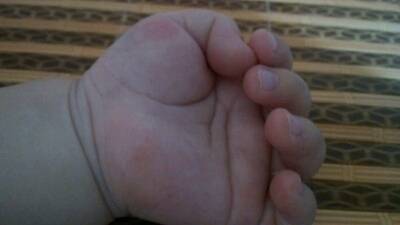宝宝手感染真菌,月子里我就发现宝宝手指脱皮了,以为是缺少维生素