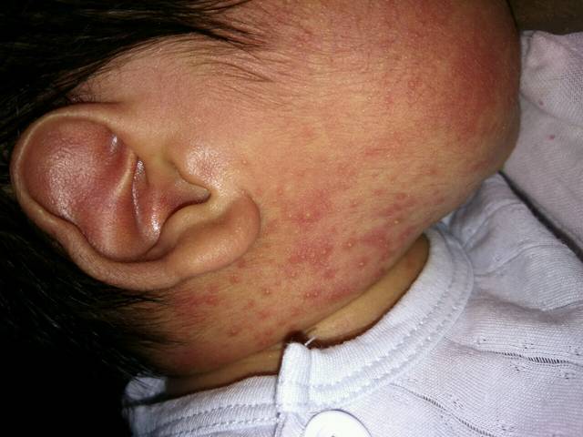 湿疹和痤疮区别?_我家宝宝出生18天了,最近脸