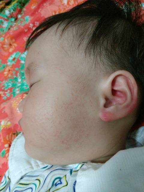 宝宝脸上是湿疹还是毛囊角化症?