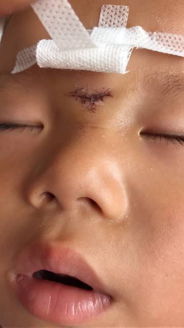 求助如何去除或减小宝宝脸上缝针疤痕