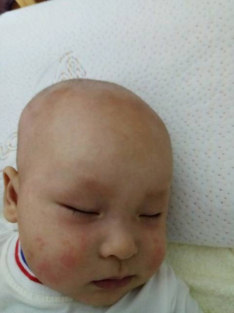 疹_宝宝六个月突然发烧三天,三天后热退疹出。