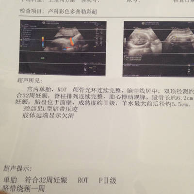 怀孕32周了去产检,脐带绕颈一周,而且显示颈部