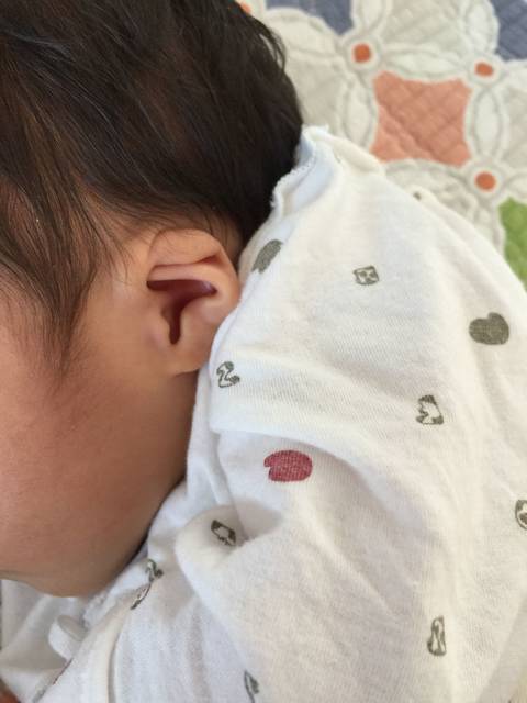 宝宝耳朵发育不良