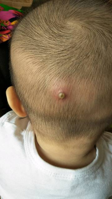 宝宝头上长小脓包