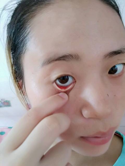 有懂的宝妈们帮忙看看,下眼睑长的是个