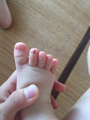 有宝妈遇到过宝宝脚指甲上有条黑线吗,上海哪里看皮肤