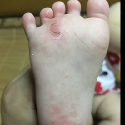 宝宝脚底红红的一片,不知道是湿疹还是脚气,用