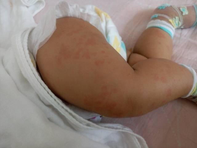 过敏性皮炎 急性荨麻疹 宝宝身上起疹子_过敏