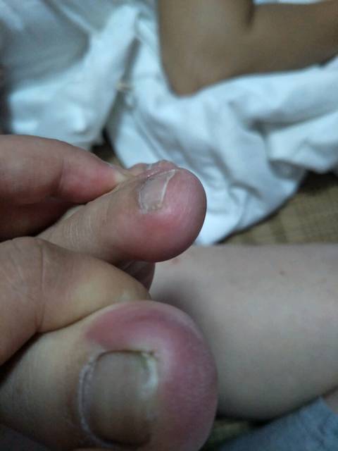 左边大拇指脚趾头肿了怎么回事?