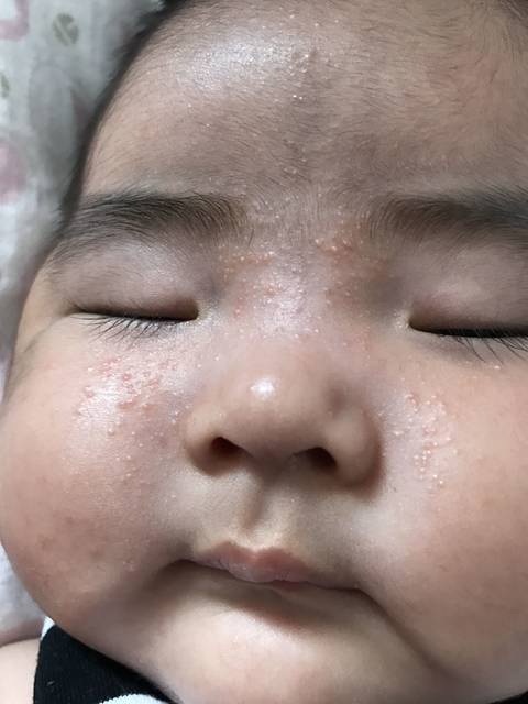 三个月宝宝脸上长像粉刺一样的小疙瘩!_三个月