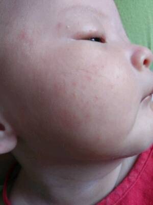哪位宝妈认识,这是痱子还是湿疹?脸上,脖子里