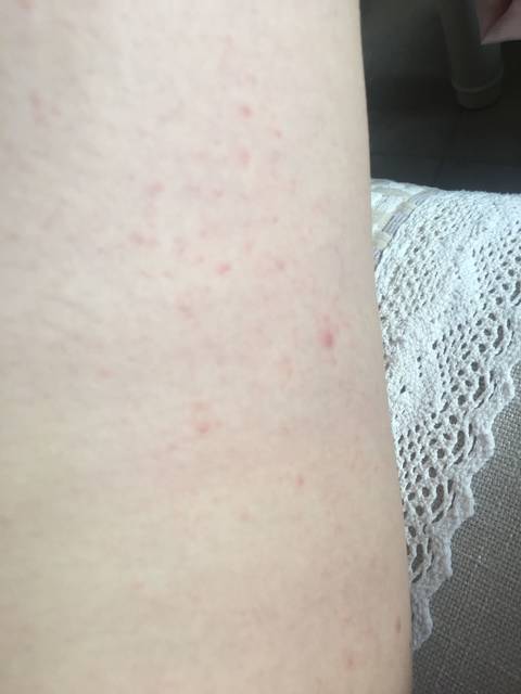 这是什么 是湿疹吗 有点痒 大腿内侧有