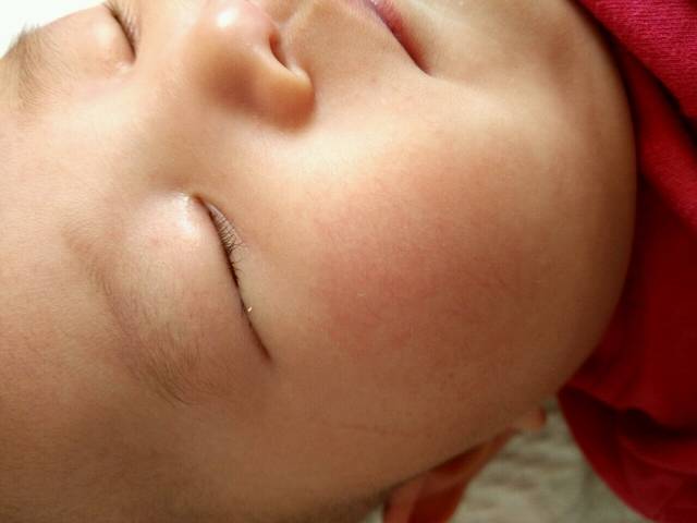 4个月宝宝脸部发红,有血丝