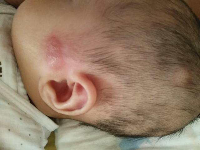 谁知道这是怎么了。三个月宝宝 耳朵与脸颊处