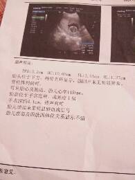 胎心儿心率145bpm是男孩还是女孩