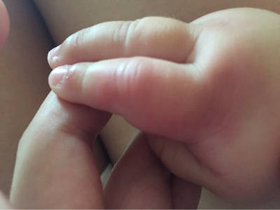 宝宝的手指不知道被啥咬了,这么肿?就食指。但