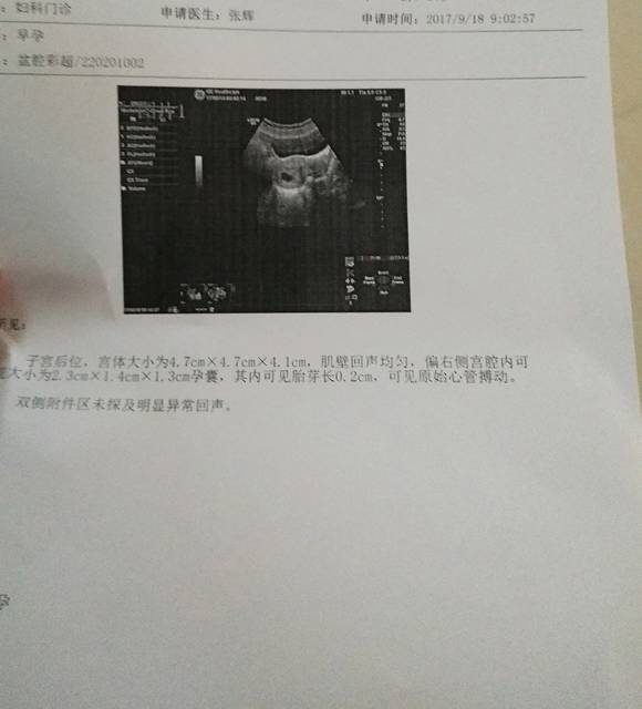 怀孕44天昨晚突然流褐色血,好担心,今天b超出